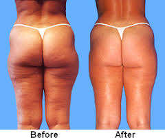 Lose 5 - 23 cm's of total body fat per hour !! Get ready for summer NOW!!
