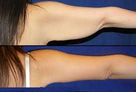 ALL NEW - Upper Arm shape - Get rid of the flab