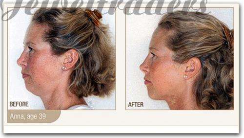 JT - Neckline Slimmer Firms, Tightens & Tones muscles of the neck