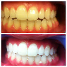 Bright White ~Teeth Whitening Pen Tooth Gel Whitener Bleaching System ~ Instand Staitn Removal
