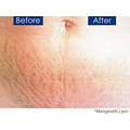 Strech Marks Remover Cream