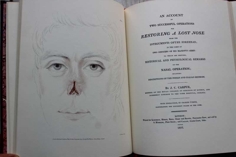 Restoring a lost nose- Carpue