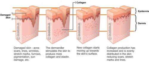 4 in 1 Derma Roller