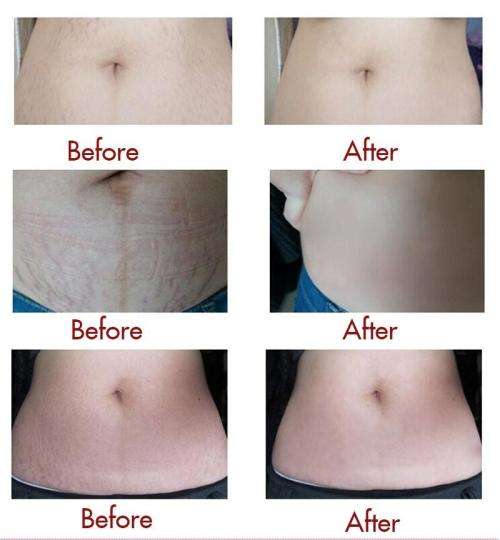 Snail Stretch Marks Cream