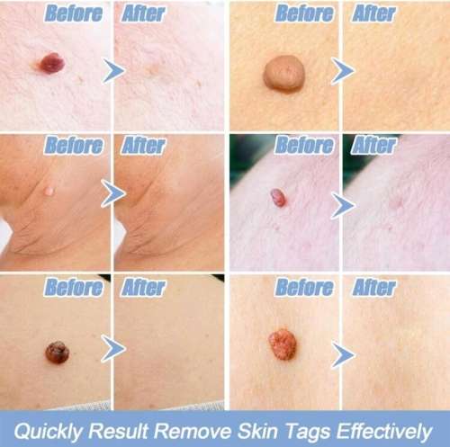 Skin Tag Remover Kit - THAT WORKS!