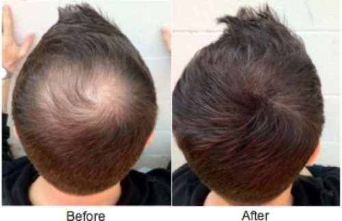 TrichoMed Minoxidil Spray 5% For Hair Loss - 60ml (3 Month Supply)