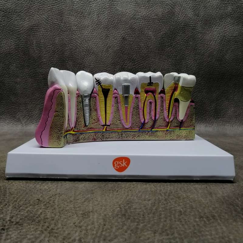 Super Cool!!! Large Dental Model Of Dental Work With Removable Tooth!!!