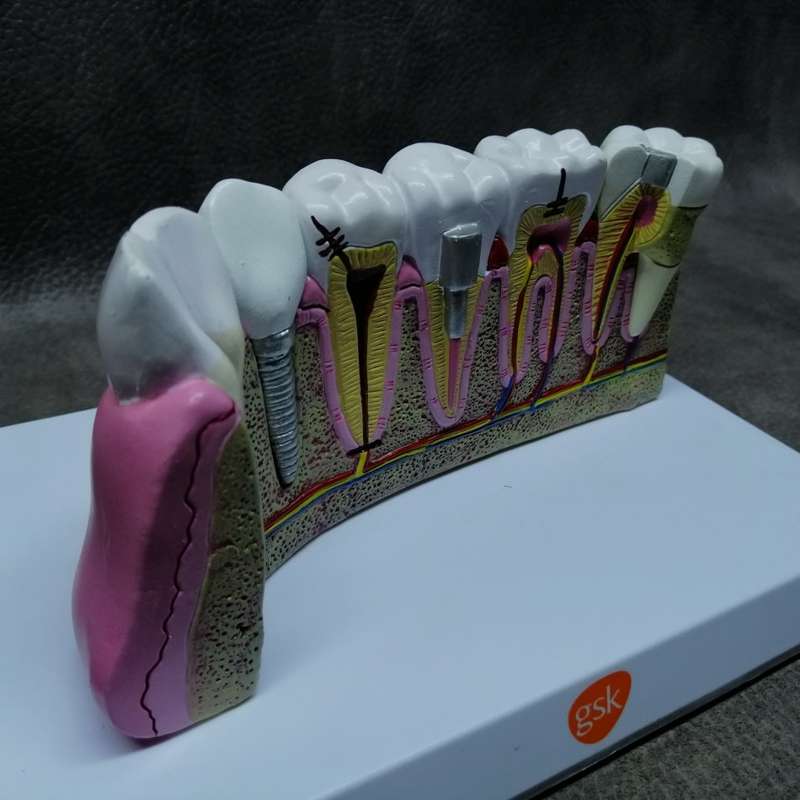 Super Cool!!! Large Dental Model Of Dental Work With Removable Tooth!!!