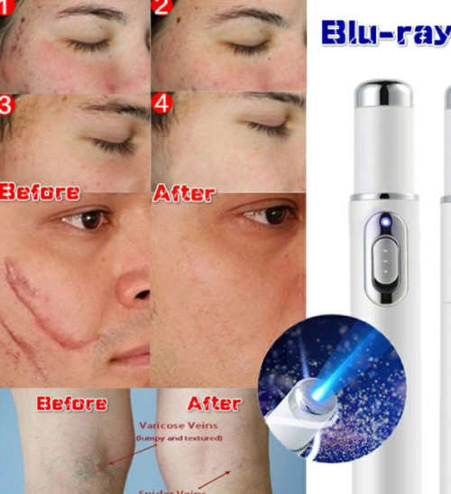 Blue-ray laser treatment pen. Fast,pain free marks,vein spot removal