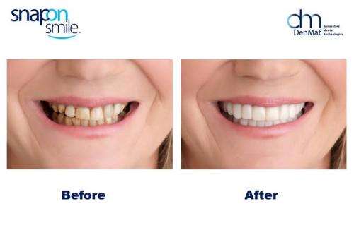 Snap on Smile Teeth veneers