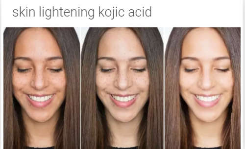 Skin lighting with kojic acid and glutathione