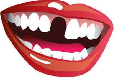 FIX-YOUR-SMILE - D.I.Y. temp replacement tooth 10g