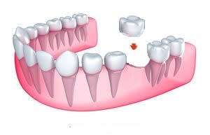 FIX-YOUR-SMILE - D.I.Y. temp replacement tooth 10g