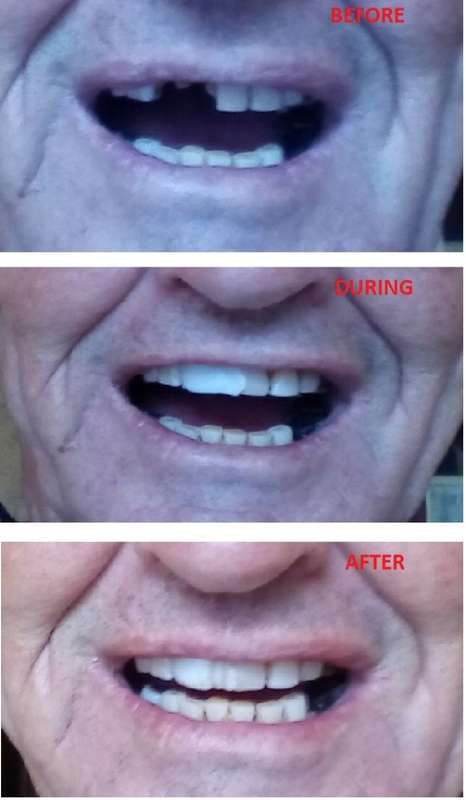 FIX YOUR SMILE Cosmetic dental product - VALUE PACK