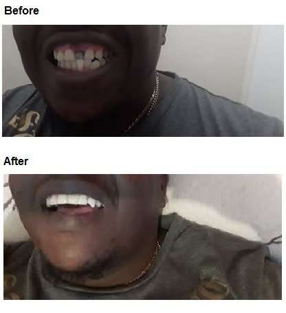 FIX-YOUR-SMILE  - BLACK FRIDAY (WEEKEND) SPECIAL.