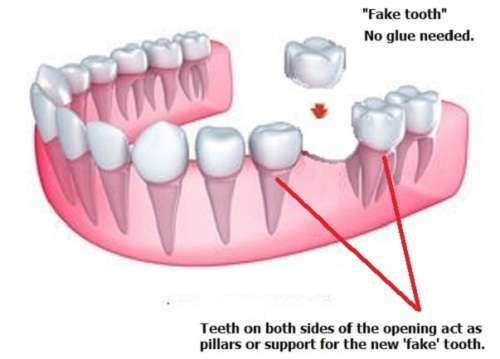 FIX-YOUR-SMILE - D.I.Y. temp replacement tooth 5g