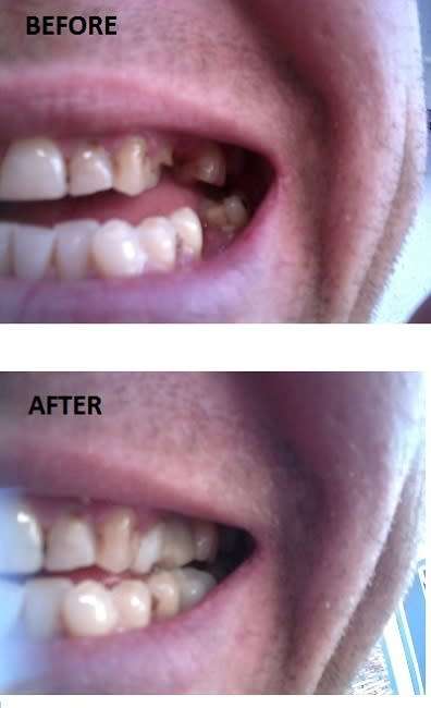 FIX-YOUR-SMILE - D.I.Y. temp replacement tooth 5g
