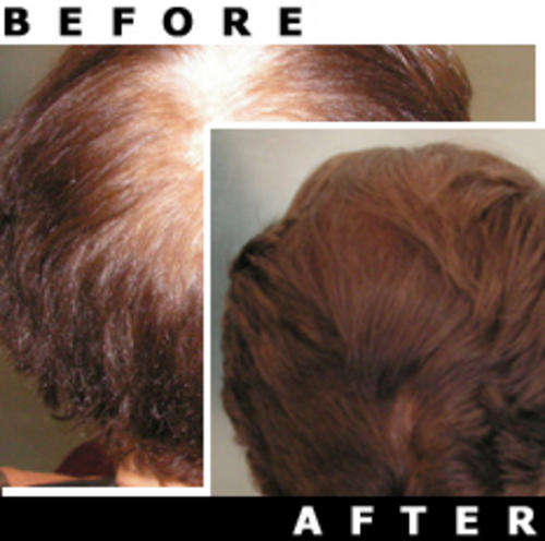 PHOTENZA Laser Therapy Machine for Hair Loss, Acne, Pain, Burns, Scars, Wrinkles, etc.