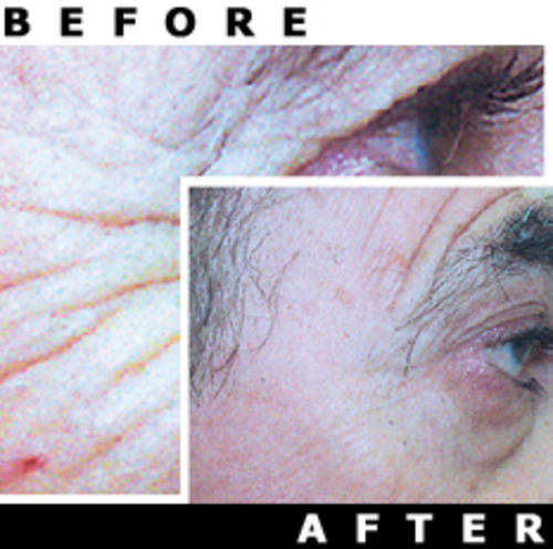 PHOTENZA Laser Wand, ANTI-AGING, Hair Loss, Acne, Pain, Burns, Scars, Wrinkles, etc.