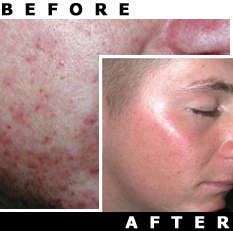 PHOTENZA Laser Therapy Machine for ACNE, Hair Loss, Age Reversal, Pain, Burns, Scars, Wrinkles, etc.