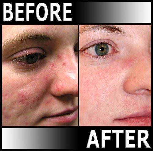 PHOTENZA Laser Therapy Machine for Hair Loss, Acne, Pain, Burns, Scars, Wrinkles, LLLT, etc.