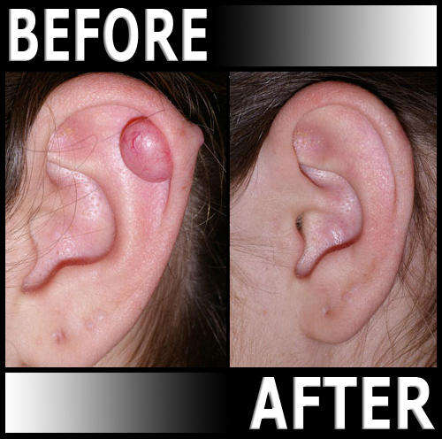 PHOTENZA Laser Therapy Machine for Hair Loss, Acne, Pain, Burns, Scars, Wrinkles, LLLT, etc.