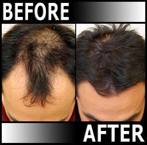 Laser Therapy in the comfort of your own home - Photenza