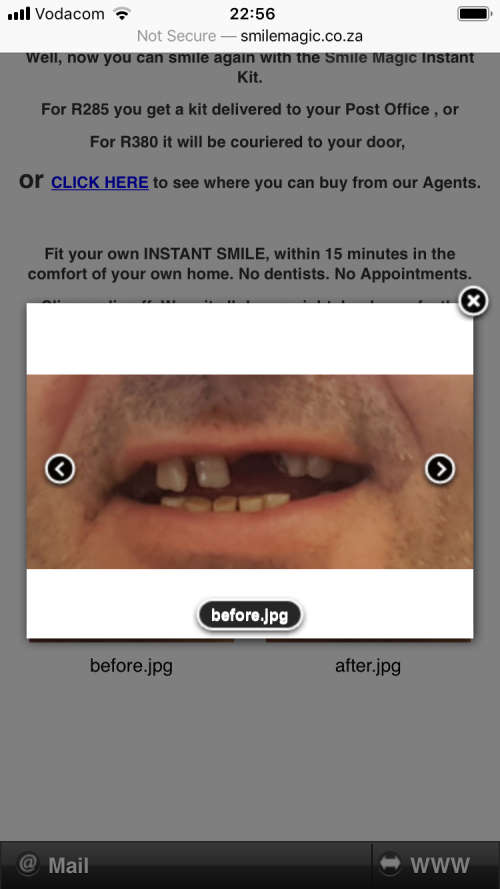Instant Smile Kits