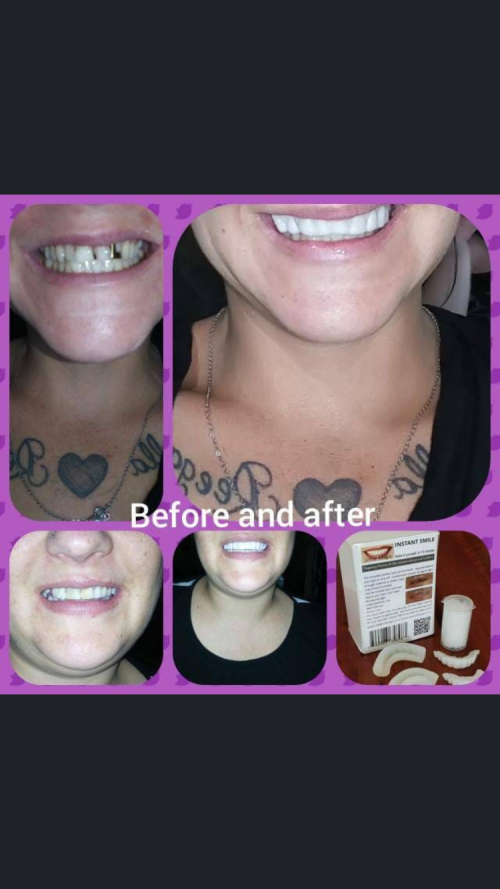 Instant Smile Kits