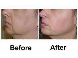 ***Reviva Lift Kit (Non Surgical Facelift)***SUPER IMPRESSIVE RESULTS!!!FREE SHIPPING ON THIS ITEM!