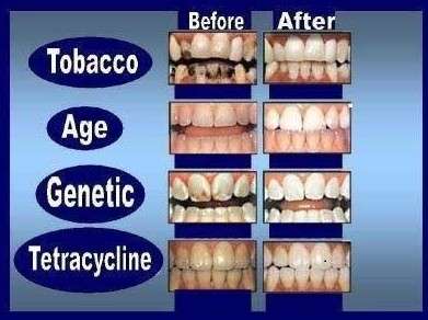 TEETH   WHITENING KIT GUARANTEED