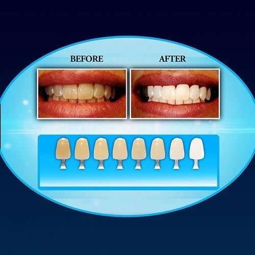 Teeth Whitening LED Technology Bright Smile White Dental Men Women Oral Hygiene