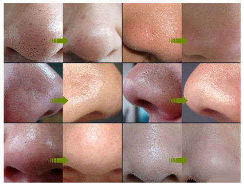 XIUZILM Blackhead Remover Deep Cleansing Purifying Peel Acne Black Mud Face Mask