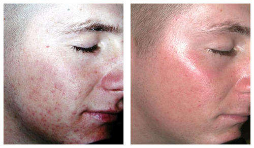 LT Wand Laser Therapy @ Home - ACNE - WRINKLES - CELLULITE - HAIR LOSS - PAIN - SCARS - MUCH MORE...