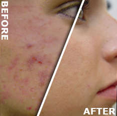 LLLT LT Wand: Acne - Hair Loss - Celluite - Wrinkles - Look younger in minutes! ***BULK R1.00 - LLLT