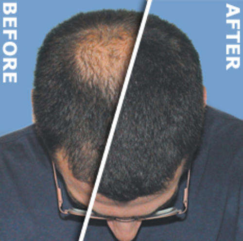 Laser Therapy Wand: Acne - Hair Loss - Celluite - Wrinkles - Look younger in minutes! DONT MISS OUT!