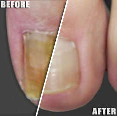 Laser Therapy LT Wand: Acne - Nails - Hair Loss - Celluite - Wrinkles - Look younger in minutes!