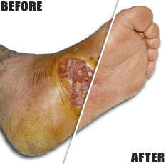 LT WAND: Wound Healing - Diabetic Ulcers - Blood Circulation - Scars - LLLT