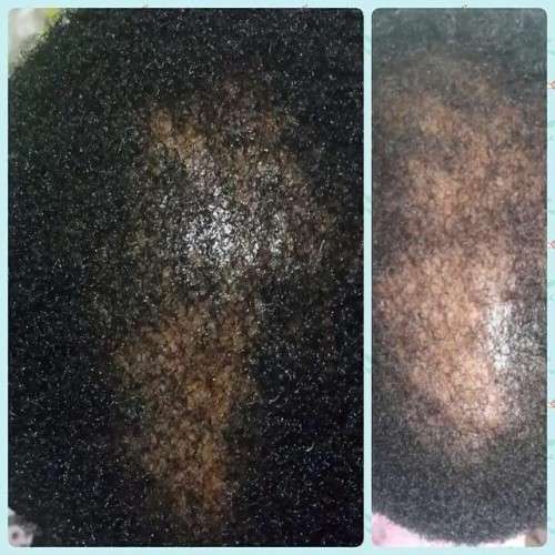 Restore Hairline, Grow Hair - NuLengths African Hair Growth Treatment - Stop Hair Loss Now!
