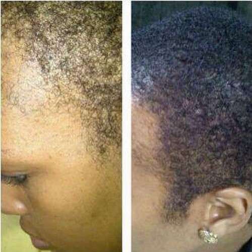 Restore Hairline, Grow Hair - NuLengths African Hair Growth Treatment - Stop Hair Loss Now!