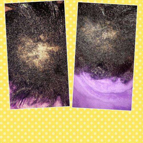 Restore Hairline, Grow Hair - NuLengths African Hair Growth Treatment - Stop Hair Loss Now!