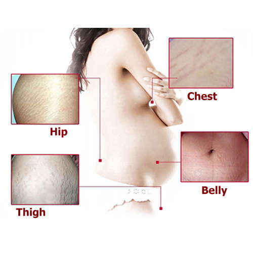 Stretch Marks Removal Cream Postpartum Repair Remover Skin Scar Body Treatment Cellulite