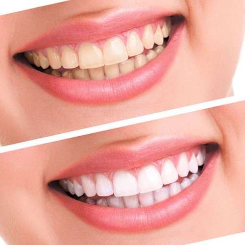 Teeth Whitening 44% Peroxide Dental Bleaching System Oral Gel Kit Tooth Whitener Denta Equipment