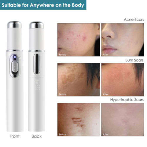 Blue Light Therapy Acne Laser Pen Soft Scar Wrinkle Removal Treatment Device Facial Massager Eye Ski