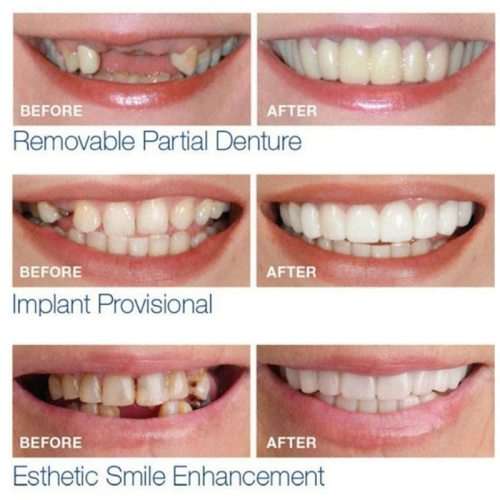 Full Set Teeth Veneers