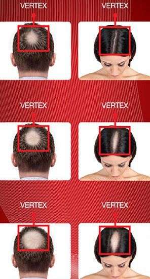 Foligain P2 2% Minoxidil Hair Regrowth Treatment for Men & Women - 60ml (3 Month Supply)