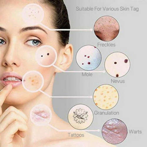 Varicose veins  Pen (Blue Light Therapy) `LOCAL STOCK`