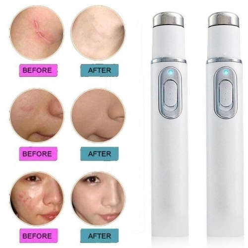 Varicose veins  Pen (Blue Light Therapy) `LOCAL STOCK`