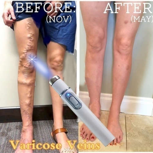 Varicose veins  Pen (Blue Light Therapy) `LOCAL STOCK`