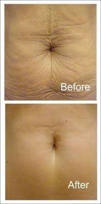 Ultrasonic Cavitation Machine